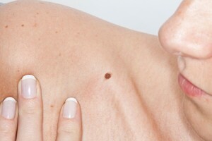 Emiten recomendaciones para prevenir el cáncer de piel - ADN Digital