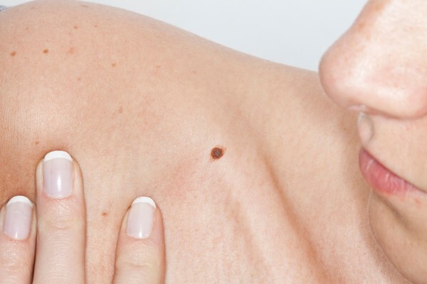 Emiten recomendaciones para prevenir el cáncer de piel - ADN Digital