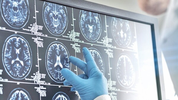 Estudio constata transmisión del alzhéimer a través de tratamiento