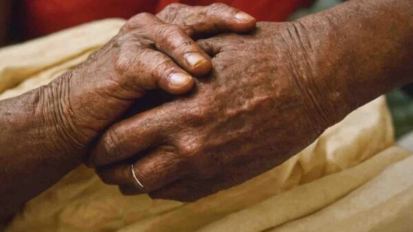El estigma de la lepra impide su erradicación, con más de 200.000 nuevos casos al año