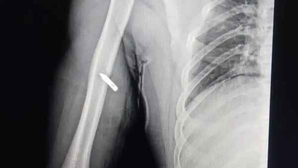 Hombre herido por policía de Puerto Guaraní fue trasladado a Concepción