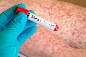 Autoridades sanitarias alertan sobre aumento de casos de sífilis en el Este - ADN Digital