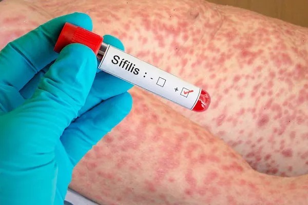 Autoridades sanitarias alertan sobre aumento de casos de sífilis en el Este - ADN Digital