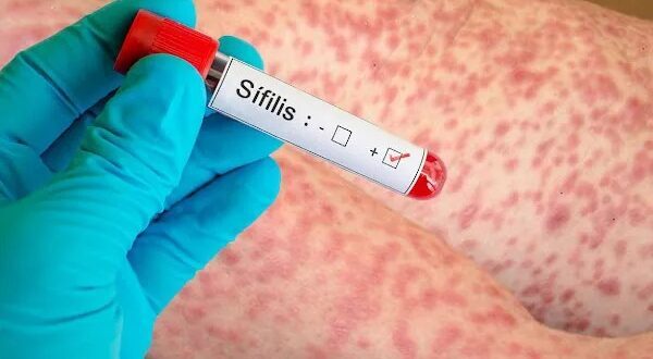 Autoridades sanitarias alertan sobre aumento de casos de sífilis en el Este