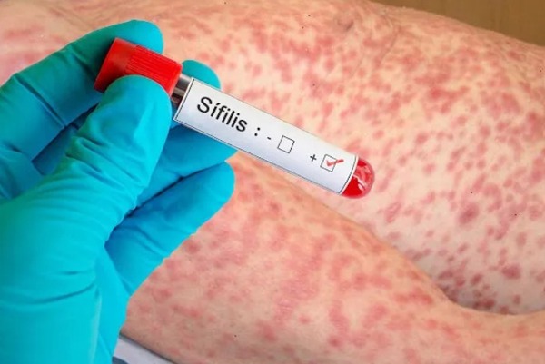 Preocupa aumento de casos de sífilis a nivel país - Megacadena - Diario Digital