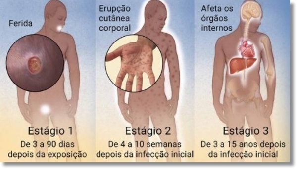 AUMENTAN CASOS DE SÍFILIS EN CDE - La Voz del Norte