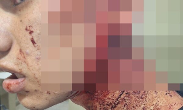 Joven fue tajeado en el rostro durante riña