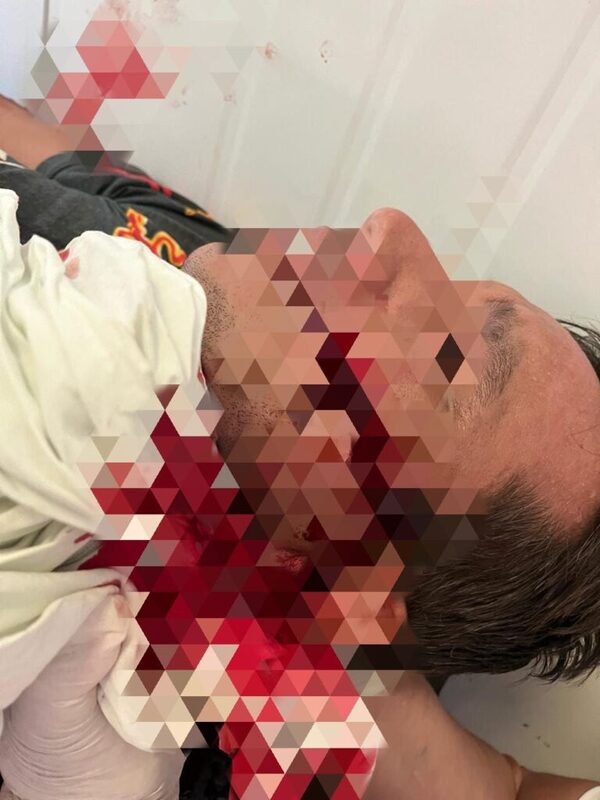 Con un machete, le cortó el rostro a su hermano durante una discusión