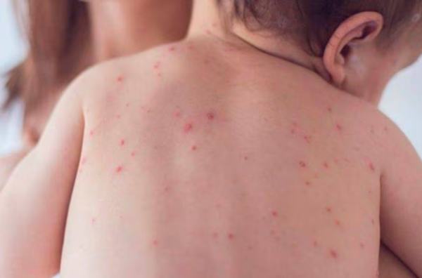 Salud en alerta ante brote de sarampión en la región