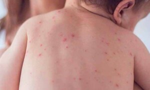 Salud en alerta ante brote de sarampión en la región – Prensa 5