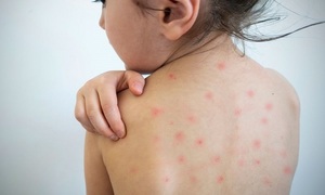 Paraguay en alerta por brotes de sarampión en la región