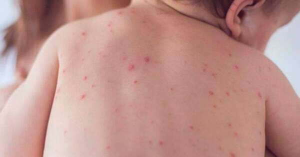 Diario HOY | Salud en alerta por los casos de sarampión en la región