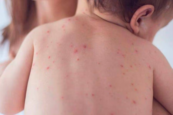 Salud en alerta por los casos de sarampión en la región