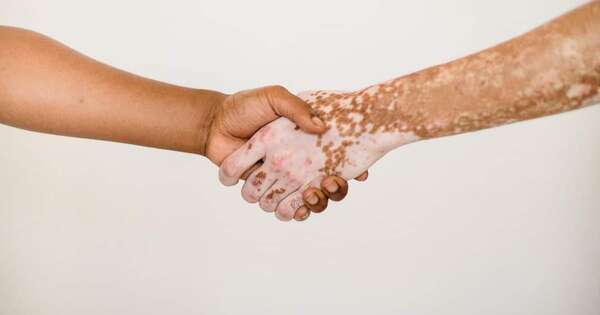 La Nación / El vitiligo requiere de tratamiento