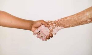 Vitiligo, un trastorno de la piel que requiere tratamientos específicos y cuidados – Prensa 5