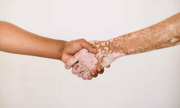 Vitiligo, un trastorno de la piel que requiere tratamientos específicos y cuidados – Prensa 5
