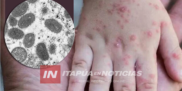 DETECTARON BROTE DE VARICELA EN ESCUELA DE LA CIUDAD ENCARNACIÓN - Itapúa Noticias