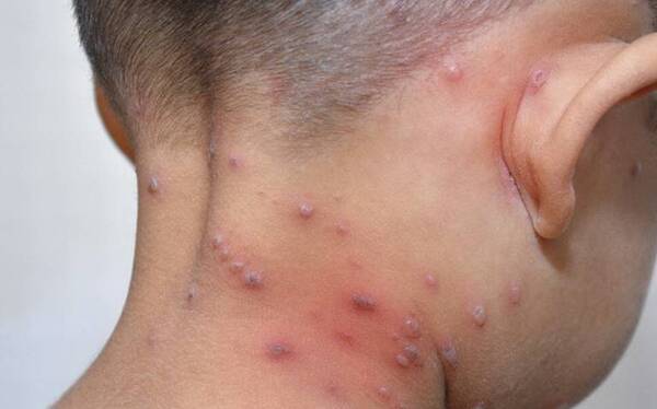 Alerta en Encarnación: Brote de varicela provoca aislamiento de alumnos por precaución - Unicanal