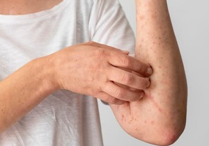 Emiten alerta por brote de varicela en Encarnación - Megacadena - Diario Digital