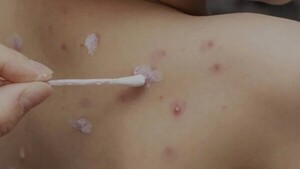 Encarnación: Reportan un caso de varicela en escuela y aíslan a 44 estudiantes