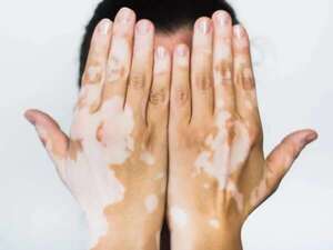 Vitiligo, un trastorno de la piel que requiere tratamientos específicos y cuidados - Estilo de vida - ABC Color