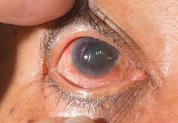 Glaucoma: El enemigo silencioso que lleva a la ceguera