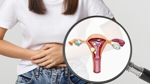 Implicancias de la endometriosis