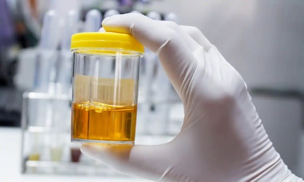 El color de la orina puede alertarnos sobre el estado de salud | Telefuturo
