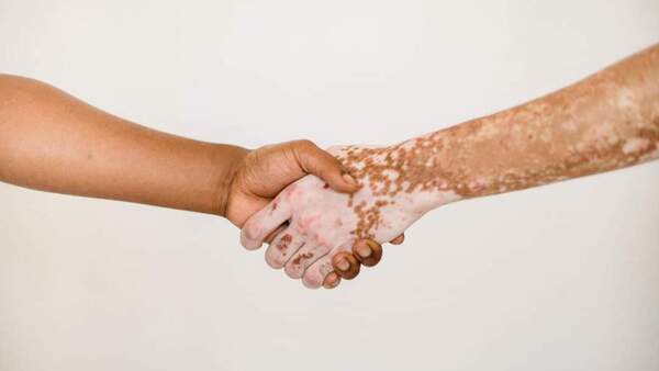Vitíligo: ¿Cómo tratar las manchas blancas?