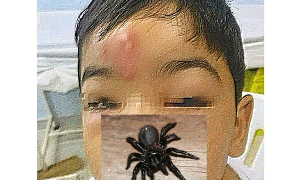 Araña venenosa picó a niño de 7 años en Ciudad del Este y está internado