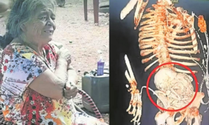 Mujer de 81 años muere tras una cirugía donde le extirparon un feto calcificado en su útero