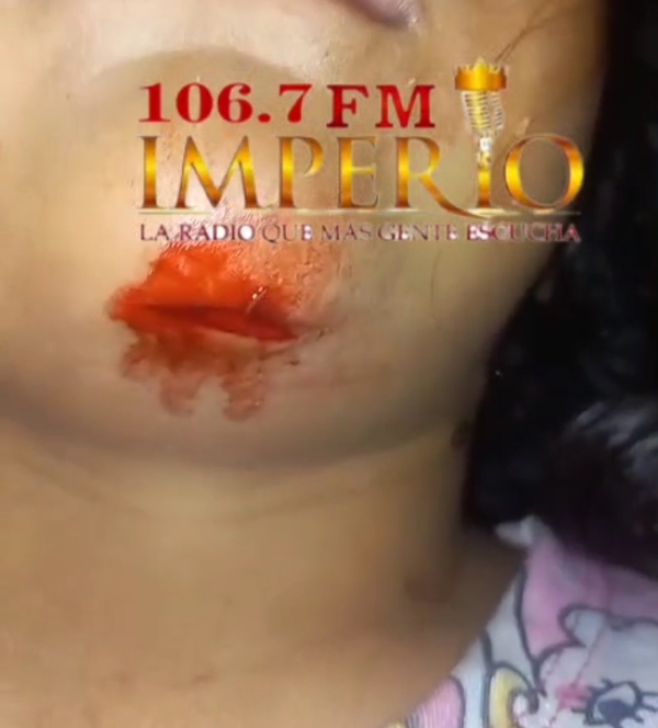 Madre afirma que no quisieron atender rápido a su hija herida en el Juan Pablo II - Radio Imperio 106.7 FM