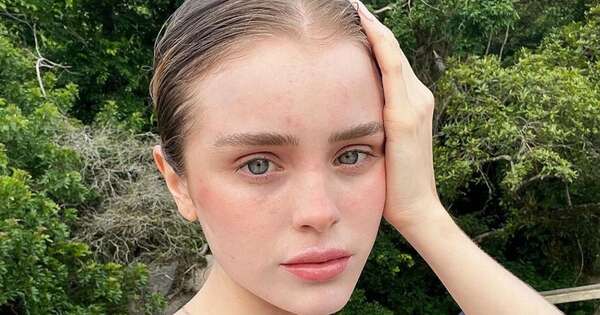 La Nación / Gaby Ovelar sufrió de escaras en el rostro ¿qué le pasó?