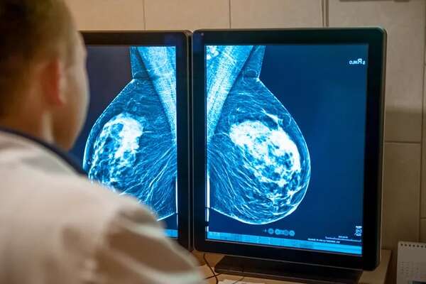 El mayor atlas de células mamarias aporta nuevos datos para prevenir el cáncer de mama  - Mundo - ABC Color