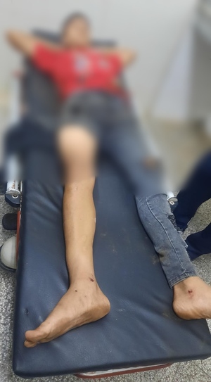 Adolescente de 15 años protagoniza accidente de tránsito y sufre fractura de pierna