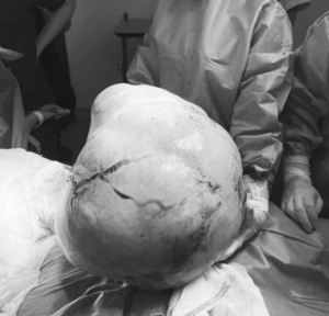 Proeza médica: extraen tumor de 9 kilos a paciente
