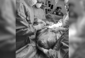 Extrajeron un tumor de 9 kilos de una paciente en el IPS