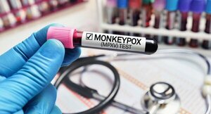 Alertan por nueva cepa del virus mpox, "viruela del mono", con potencial pandémico