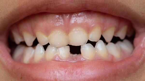 Fármaco para hacer crecer dientes se ensayará este año - La Tribuna