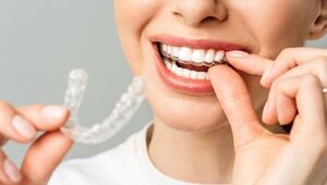 La línea de la sonrisa: alineadores invisibles impresos en 3D son lo último en ortodoncia (ya no más brackets)
