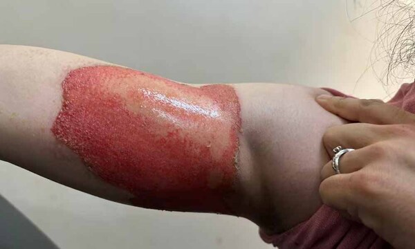 Imputan al hombre que supuestamente prendió fuego a su pareja – Prensa 5