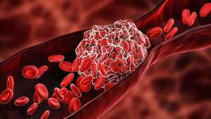 Mayor riesgo de trombos según la forma de las venas pulmonares al llegar al corazón - Ciencia - ABC Color