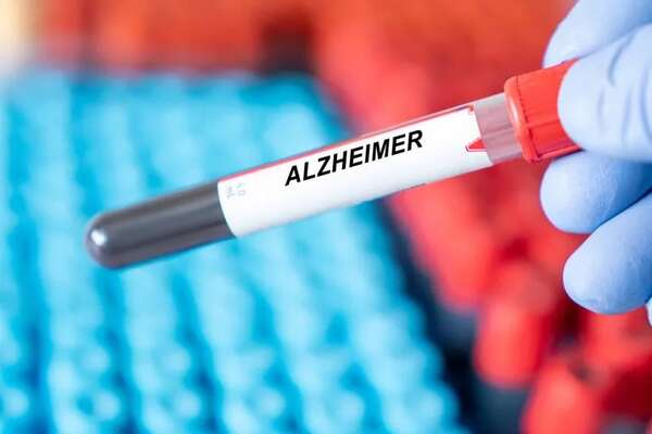 Investigadores japoneses detectan Alzheimer en etapa temprana con análisis de sangre - Ciencia - ABC Color