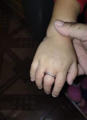 Extraen metal atascado en dedo de niña