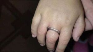 Regla de metal queda atascada en el dedo de una niña de 3 años