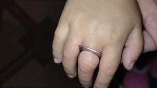 Regla de metal queda atascada en el dedo de una niña de 3 años