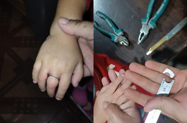 DEDO DE UNA NIÑA DE TRES AÑOS SE TRANCÓ CON UNA REGLA DE METAL