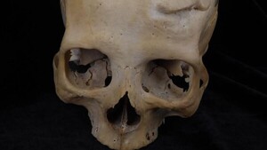 Un joven de 30 años del Antiguo Egipto, primer paciente operado de cáncer hace 4.500 años