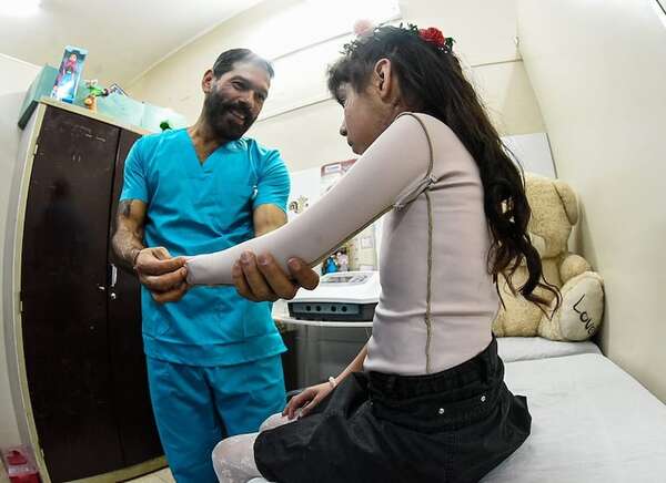 Quemaduras: más de la mitad de los pacientes que atiende el Cenquer son niños - Nacionales - ABC Color