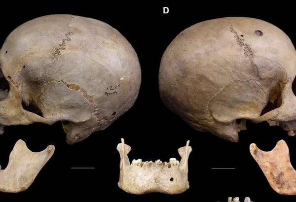 El cráneo de 4.000 años de antigüedad que revela cómo los egipcios trataron de operar el cáncer